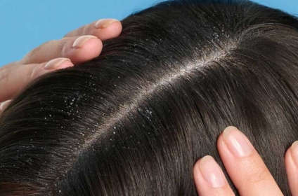 راهنمای جامع کنترل بلندمدت شوره سر: روتین دائمی، پیشگیری از عود و تفاوت شامپوهای نگهدارنده