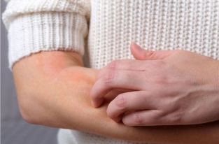 هر آنچه باید درباره اگزما بدانید