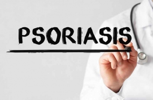 آشنایی کامل با پسوریازیس