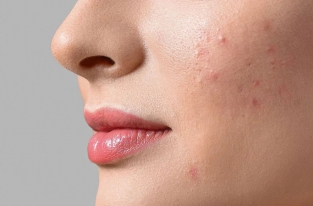 چرا جوش می زنیم؟ چطور آن را درمان کنیم؟